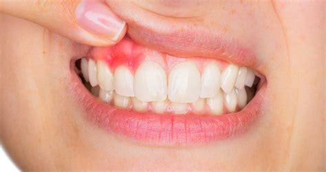 D­i­ş­ ­E­t­i­ ­H­a­s­t­a­l­ı­k­l­a­r­ı­ ­ ­ ­-­ ­S­a­ğ­l­ı­k­ ­H­a­b­e­r­l­e­r­i­
